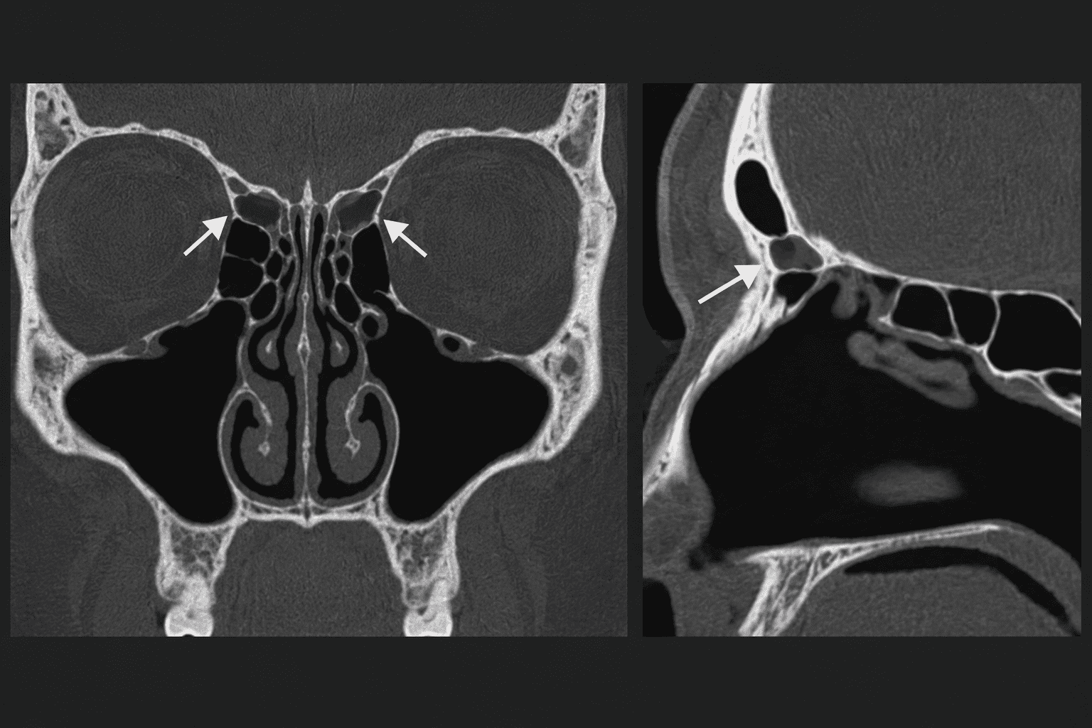 Koronare und sagittale CT-Darstellung von Agger-nasi-Zellen im Knochenfenster mit Hervorhebung der frontoethmoidalen Region und des frontalen Rezessus im Stil von radiologie24.