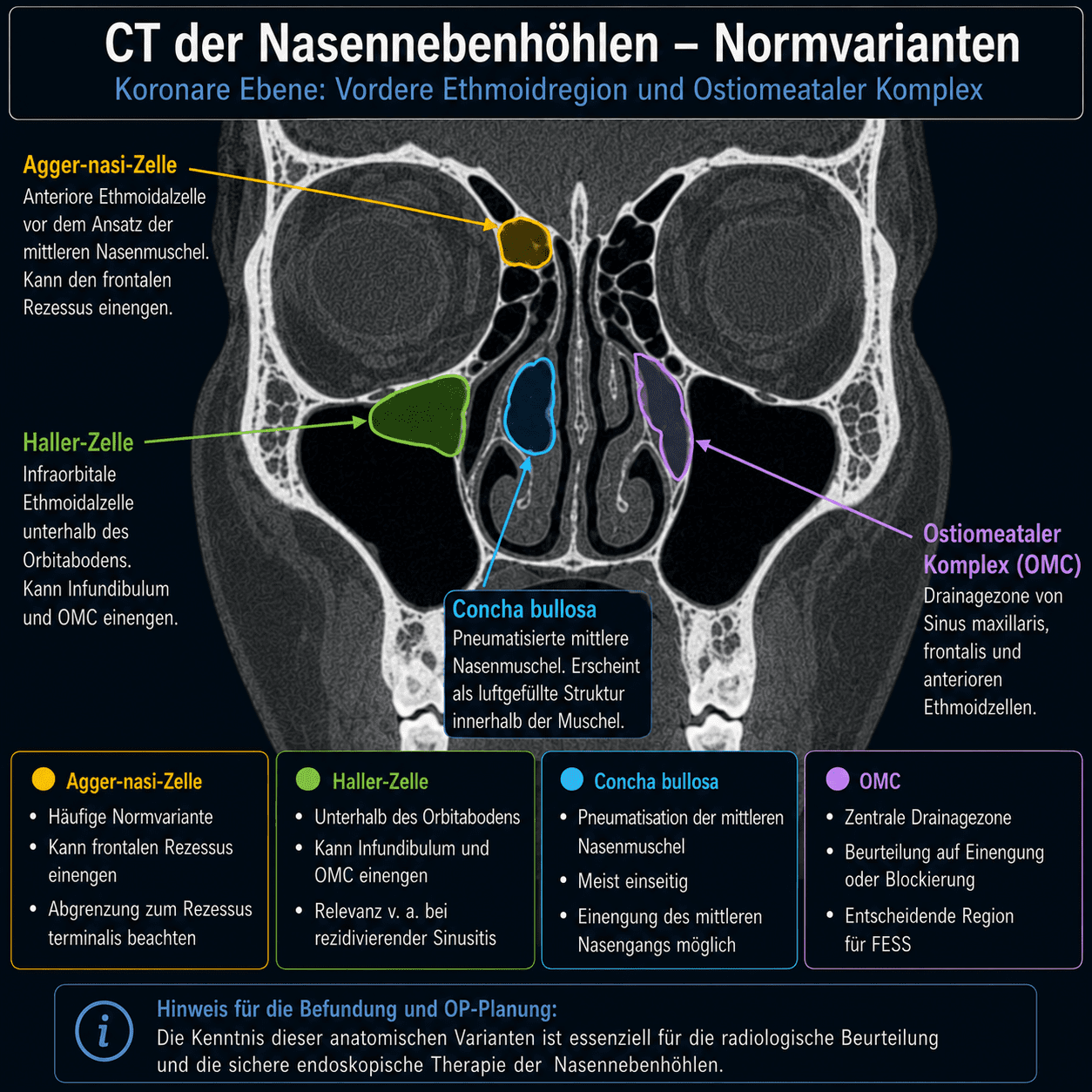 Koronare CT der Nasennebenhöhlen mit Darstellung wichtiger anatomischer Normvarianten des vorderen Ethmoids und des ostiomeatalen Komplexes. Markiert sind Agger-nasi-Zelle, Haller-Zelle, Concha bullosa und der ostiomeatale Komplex in einer didaktischen radiologie24-Grafik.
