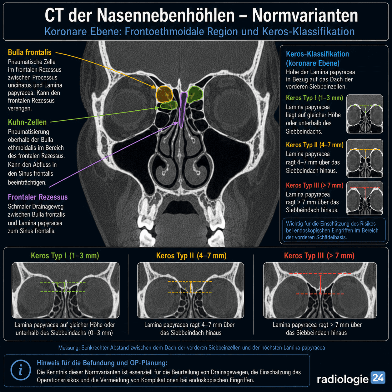 Koronare CT-Grafik der Nasennebenhöhlen mit Darstellung des frontalen Rezessus, frontoethmoidaler Zellen nach Kuhn, Bulla frontalis und der Keros-Klassifikation in einer didaktischen radiologie24-Visualisierung.