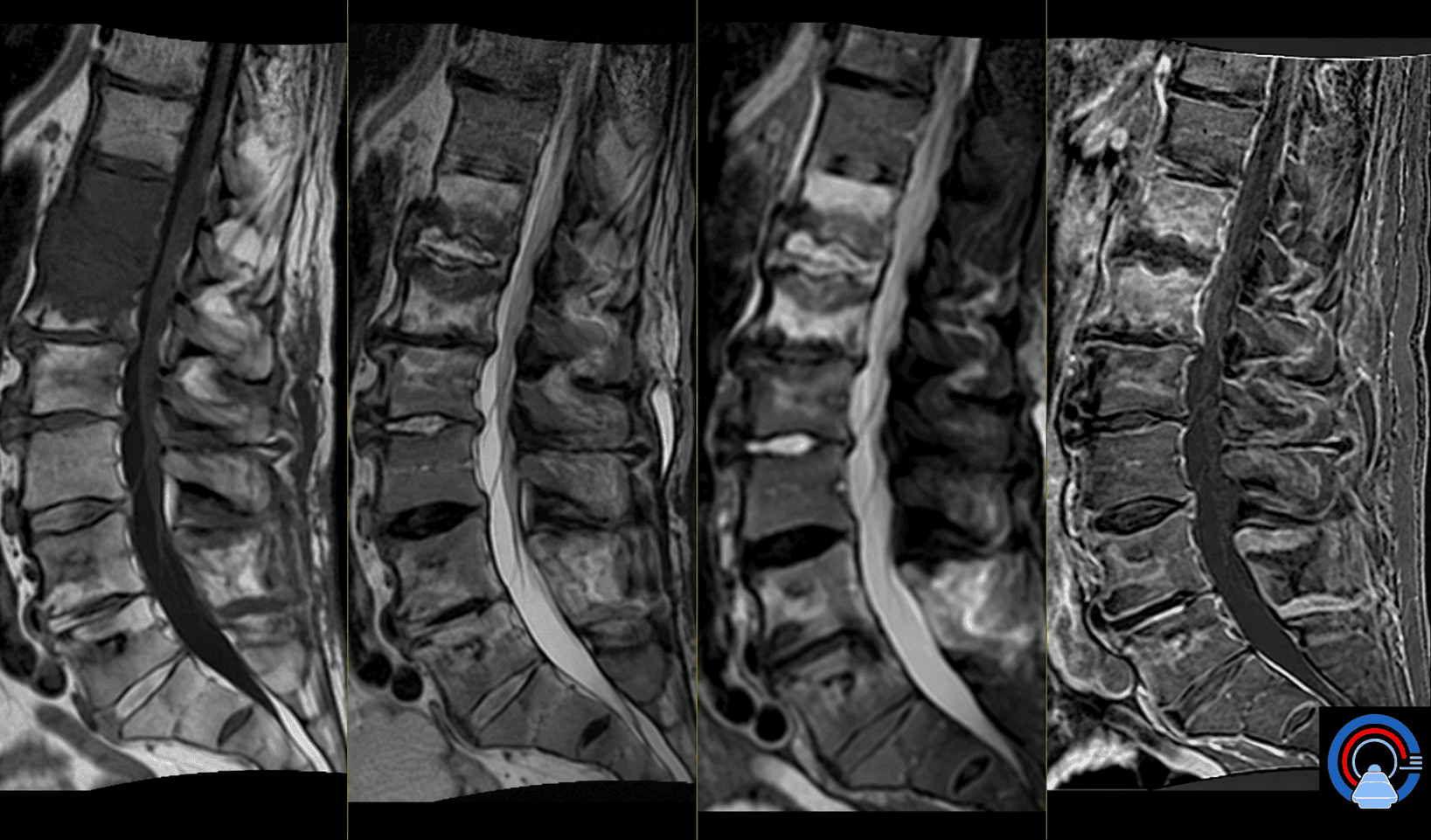 MRT einer postoperativ aufgetretenen Spondylodiszitis Th12/L1 mit Knochenmarködem und erosiven Endplattenveränderungen.