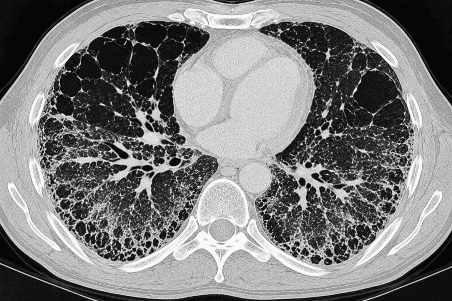 HRCT mit kombiniertem Emphysem und fibrotischem Umbau der Lunge