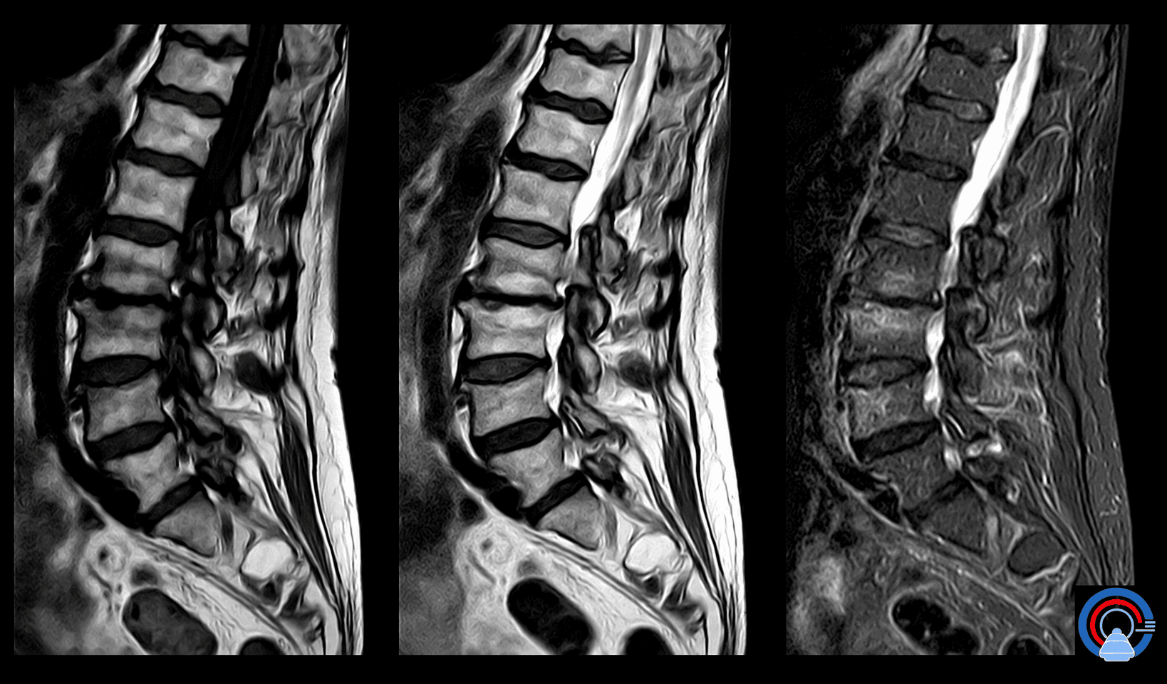 Modic-Typ-1-Veränderungen L2/3 und L3/4 mit endplattennahem Knochenmarködem bei Osteochondrose L2/3